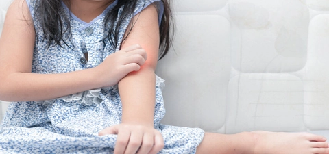 Largest paediatric trial investigates treatments for severe atopic dermatitis 