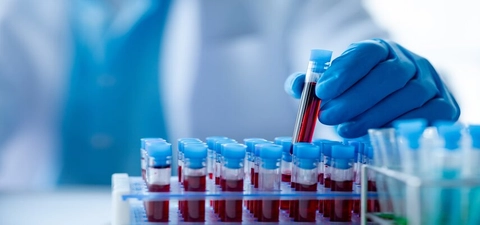New blood test for Alzheimer&rsquo;s Disease could change how the disease is detected and diagnosed