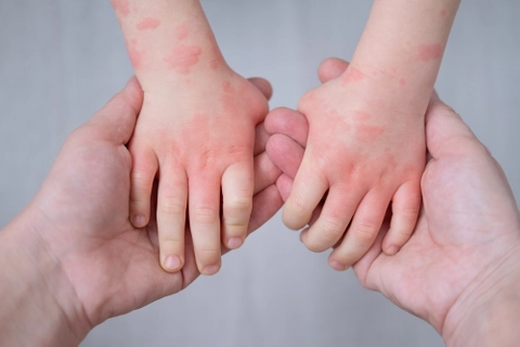 Trinity research highlights impact of eczema on child growth, and points to effective treatment  