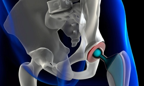 An x-ray of a hip