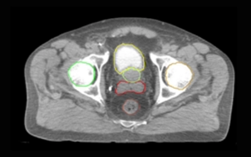 CT Pelvis