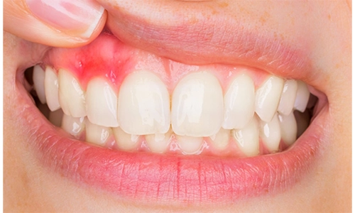 Teeth with Gingivitis
