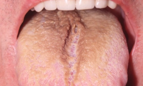 Hairy-Tongue500by300