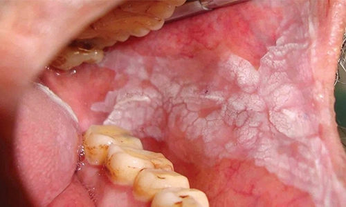 Homogeneous Leukoplakia