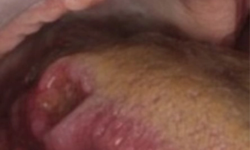 Lateral Tongue Border SCC