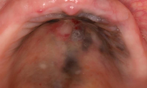 Malignant Melanoma of the Hard Palate
