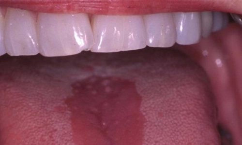 Median-Rhomboid-Glossitis500by300