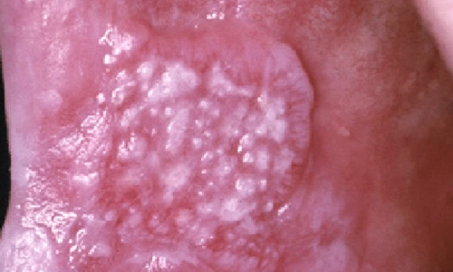 Non-Homogenous-Leukoplakia