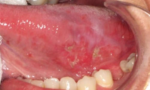 Ventrolateral Tongue SCC