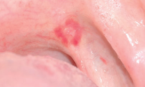Erythroplakia