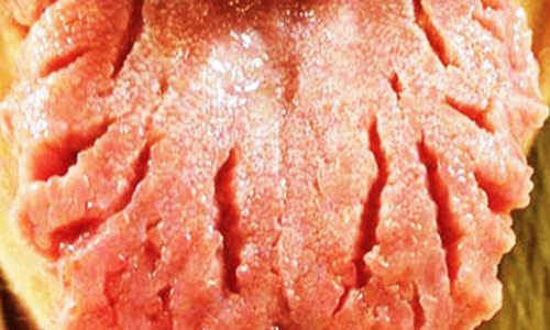 Fissured-Tongue