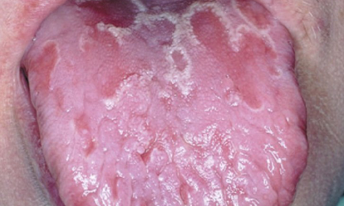 Geographic Tongue