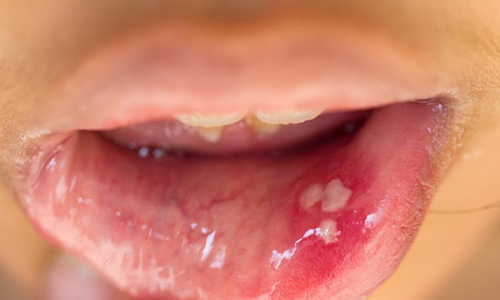 Oral-Warts