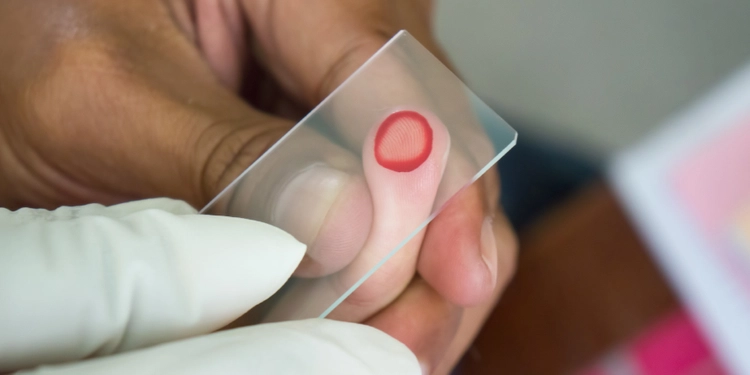 Blood drop sample on test glass plate