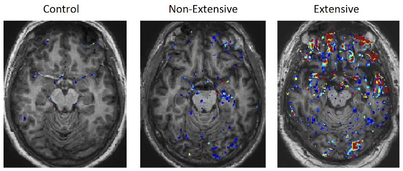Control (normal MRI brain scan); Non-extensive (red/blue pixels showing non-extensive leakage of the BBB); Extensive (red pixelation showing extensive BBB leakage in a retired symptomatic individual.